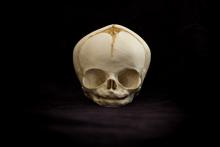 Osteo Cast Fetal Skull - 31 weeks BC-180