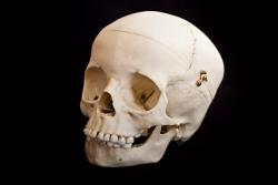 Osteo- Cast Child skull, 5 years of age, Calvarium Cut, BC-188